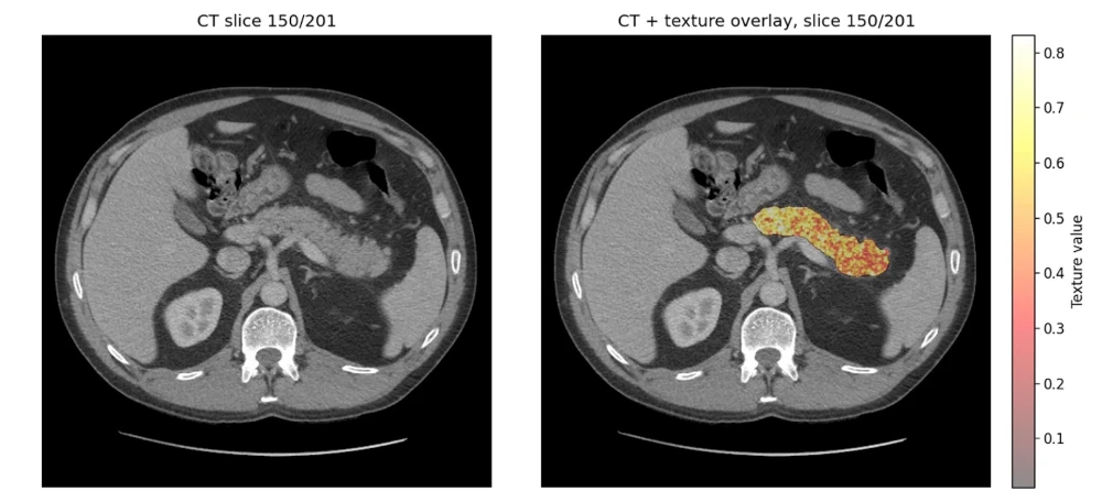 تشخیص زودهنگام سرطان پانکراس pancreatic cancer با هوش مصنوعی